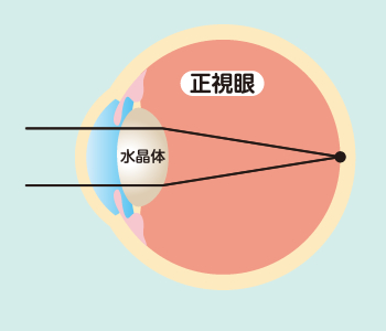 近視とは