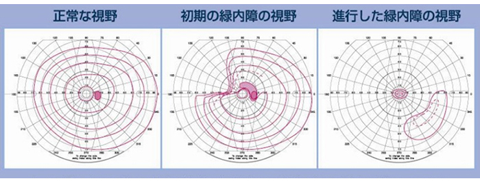 ゴールドマン視野計