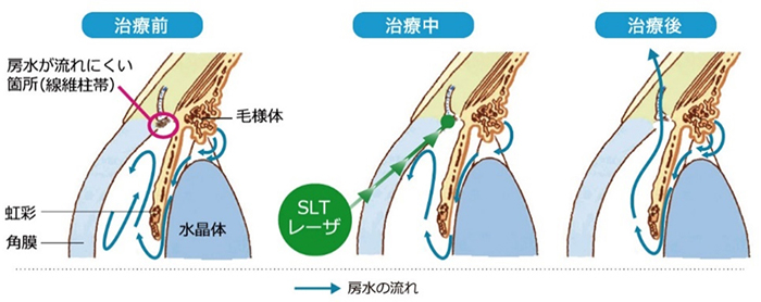 SLTレーザー