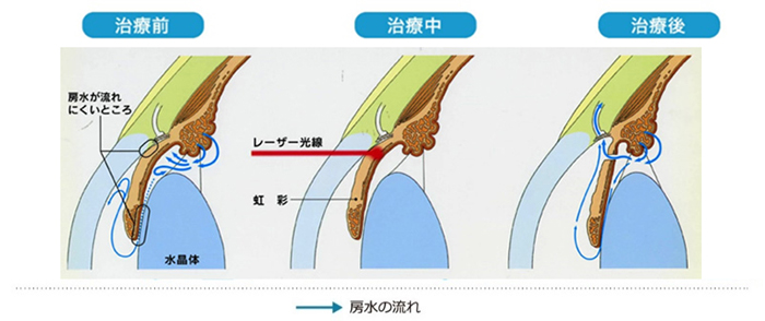 LIレーザー（閉塞隅角緑内障の治療）